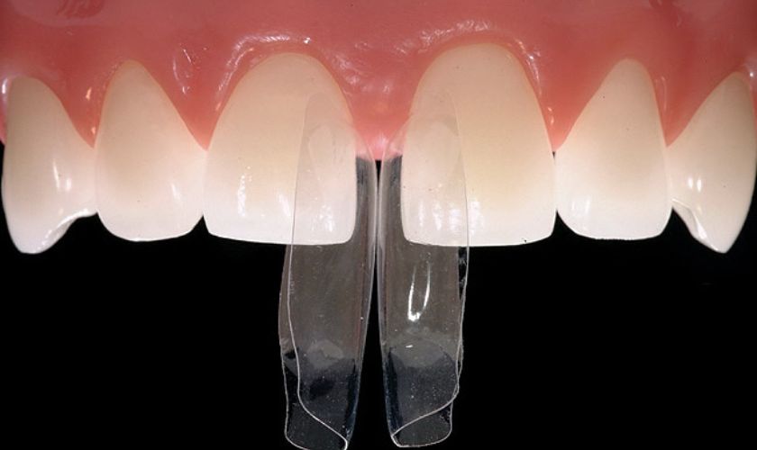 Amazing Things You Must Know About Cosmetic Bonding