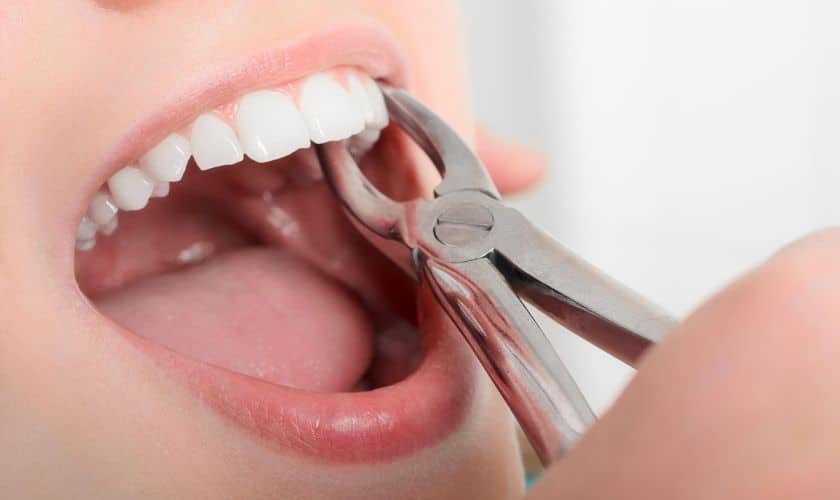 How Long Does It Take For A Tooth Extraction To Heal?