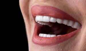 Porcelain Veneers - Cosmetic Dentist in Scottsdale, AZ - Kind Family Dentistry