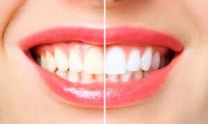 Teeth Whitening - Cosmetic Dentist in Scottsdale, AZ - Kind Family Dentistry
