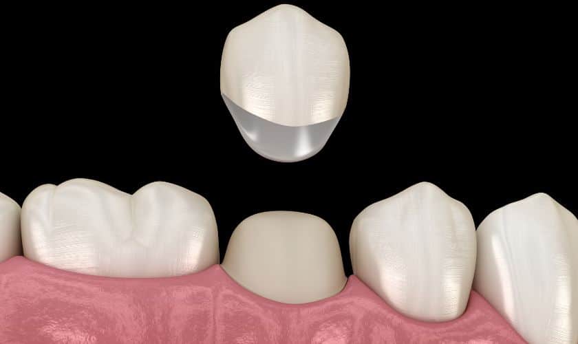 How To Maintain Your Dental Crowns in Scottsdale for a Lasting Smile