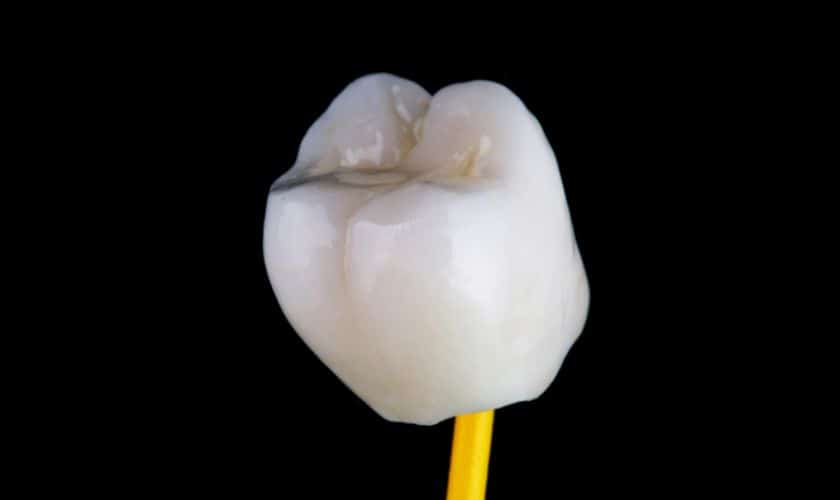 Advantages of our Dental Crowns in Scottsdale