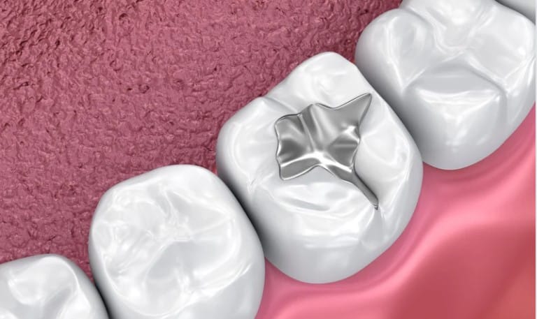 Dental Fillings Scottsdale