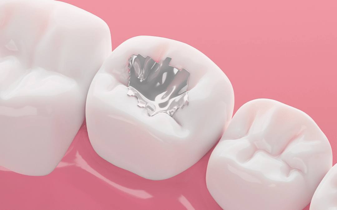 How Long Do Dental Fillings Last? 5 Key Factors That Impact Their Lifespan