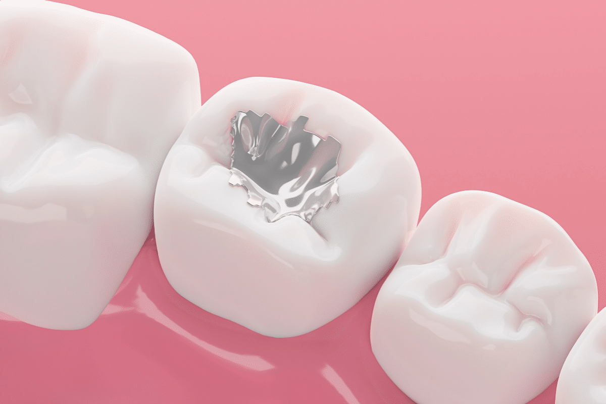 How Long Do Dental Fillings Last? 5 Key Factors to Know