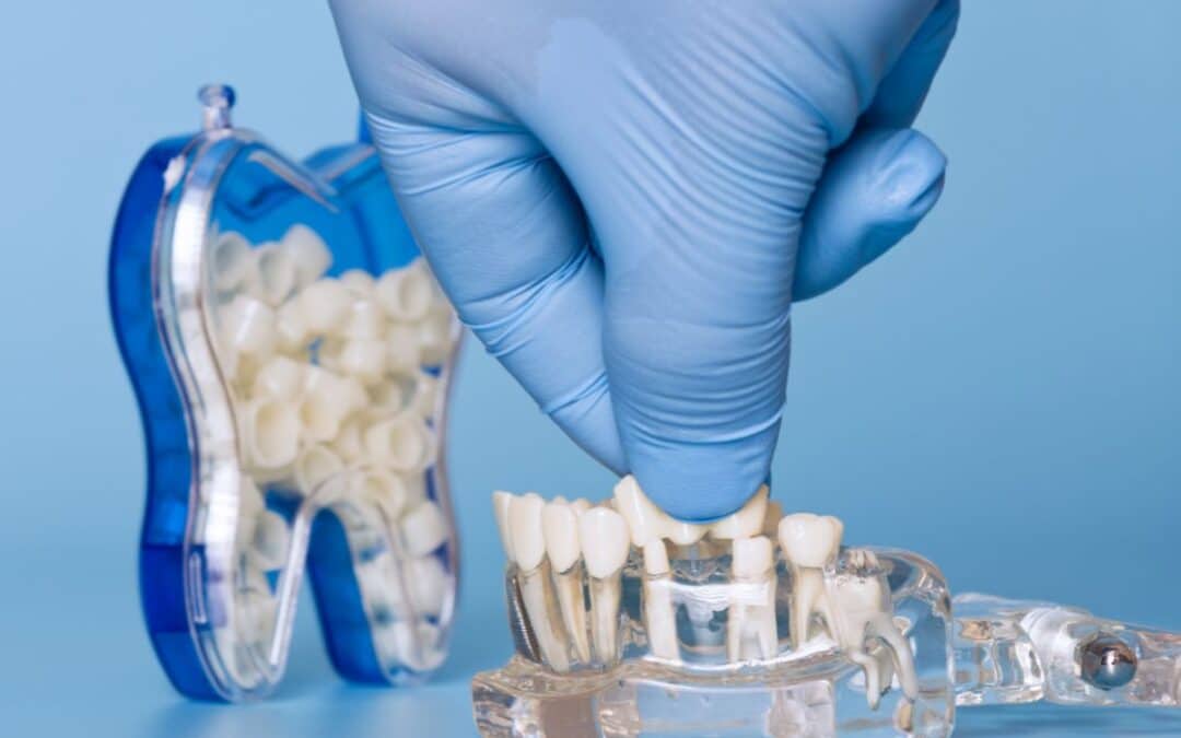 Is It Safe To Eat Spicy Food After A Dental Bridge?