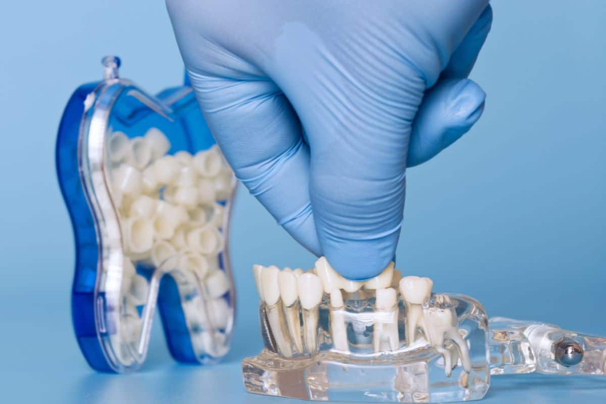 Dental Bridge in Scottsdale Dental Bridge in Scottsdale