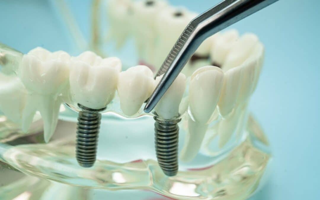 Dental Implants vs. Dental Crowns: Which Smile Solution Is Right For You?