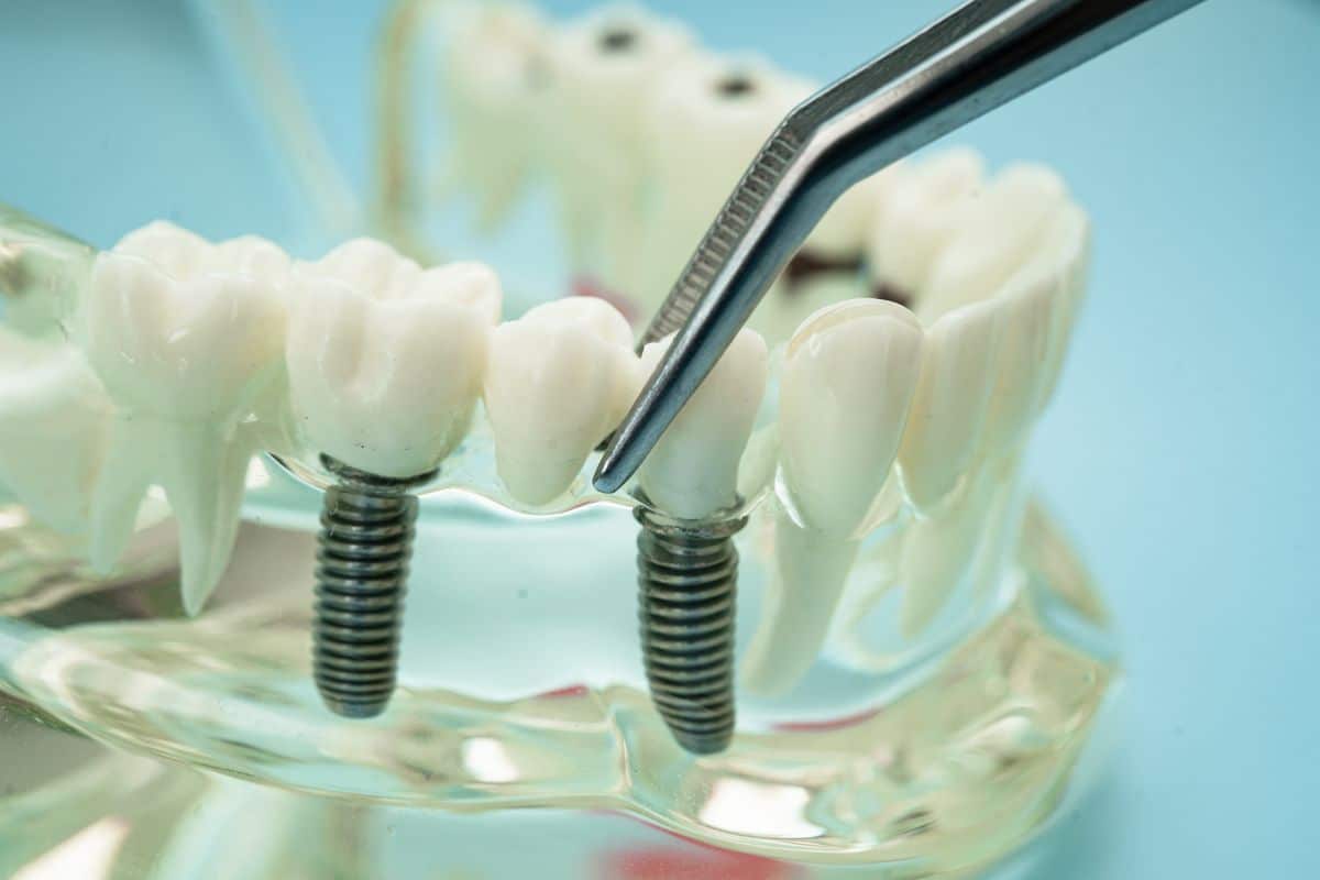 Dental Implants Scottsdale