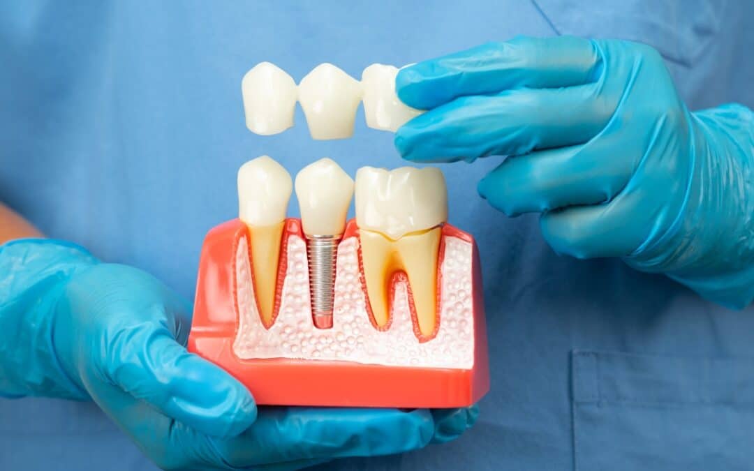 Can Dental Crowns and Implants Fix Severe Tooth Damage?