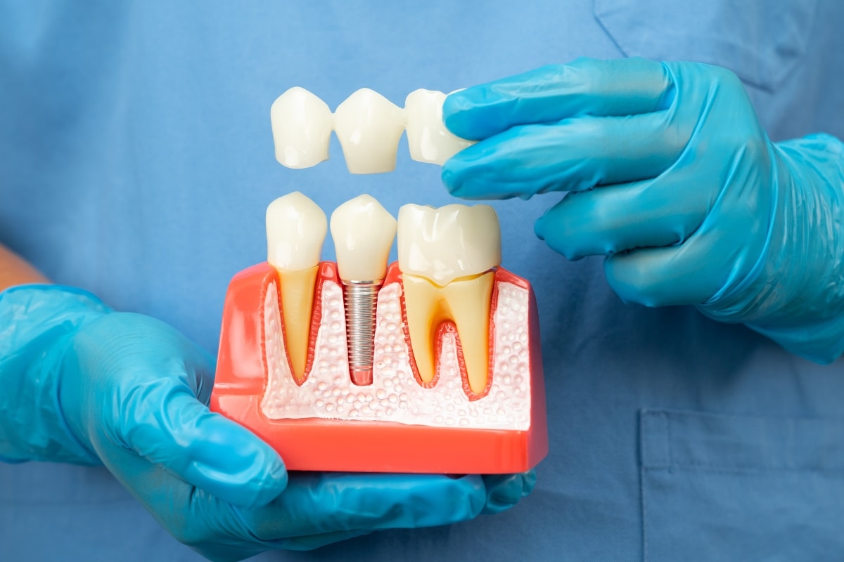 Dental Crowns Scottsdale Dental Crowns Scottsdale